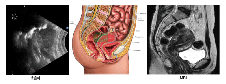 초음파 vs 모식도 vs MRI